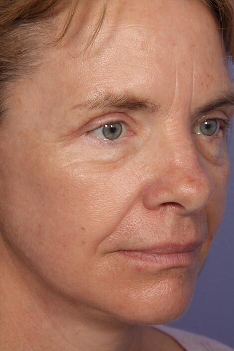 Laser Skin Resurfacing Before & After Image