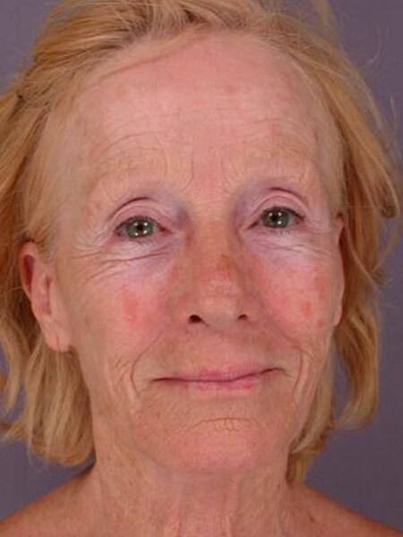 Laser Skin Resurfacing Before & After Image