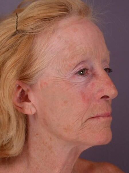 Laser Skin Resurfacing Before & After Image