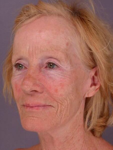 Laser Skin Resurfacing Before & After Image