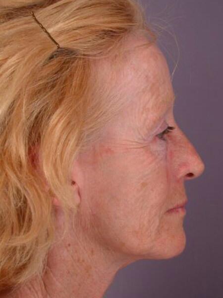 Laser Skin Resurfacing Before & After Image