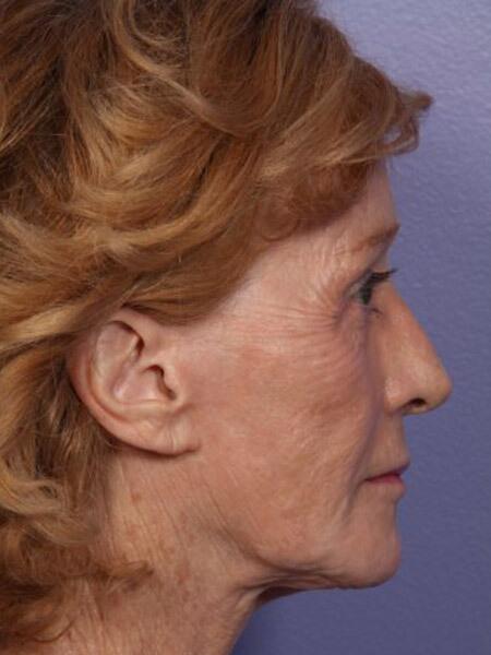 Laser Skin Resurfacing Before & After Image