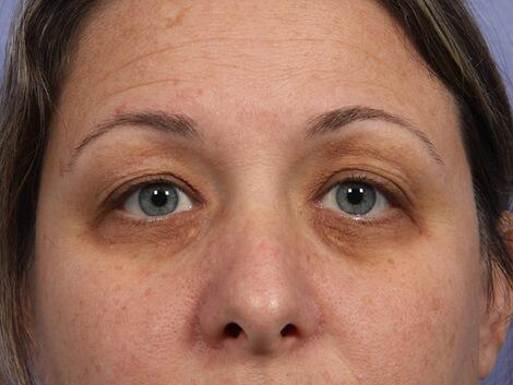 Laser Skin Resurfacing Before & After Image