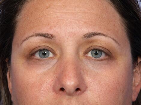 Laser Skin Resurfacing Before & After Image