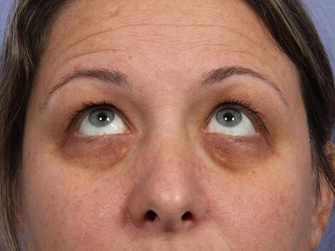 Laser Skin Resurfacing Before & After Image