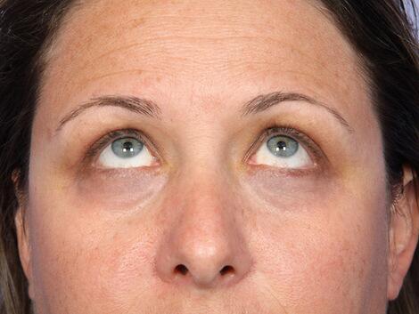 Laser Skin Resurfacing Before & After Image