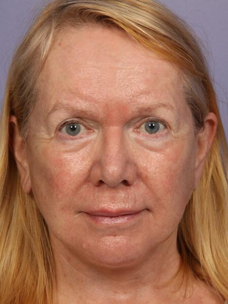 Laser Skin Resurfacing Before & After Image