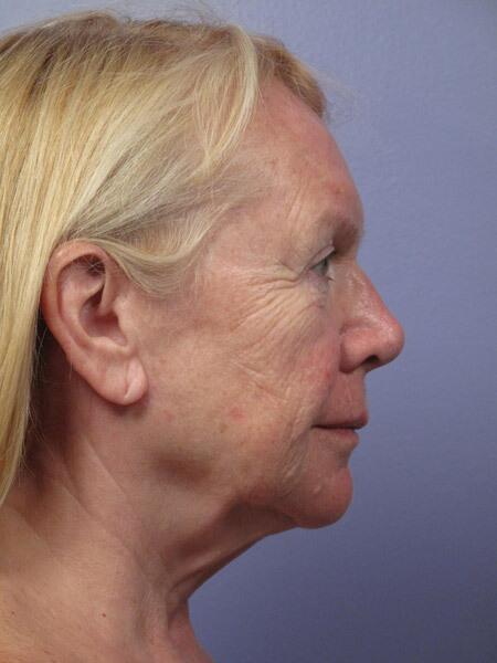 Laser Skin Resurfacing Before & After Image