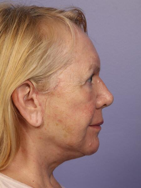 Laser Skin Resurfacing Before & After Image