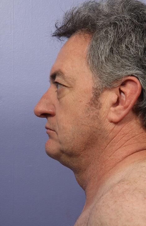 Laser Skin Resurfacing Before & After Image