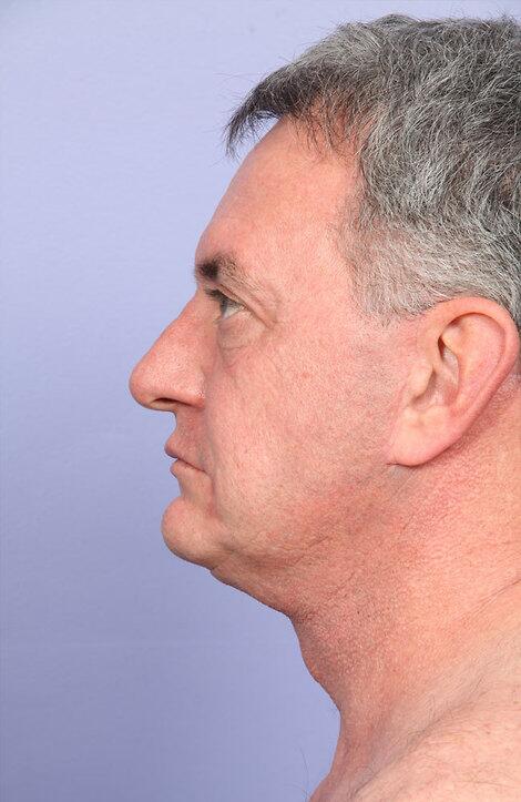 Laser Skin Resurfacing Before & After Image