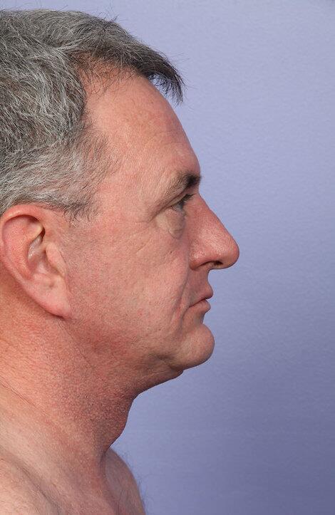 Laser Skin Resurfacing Before & After Image