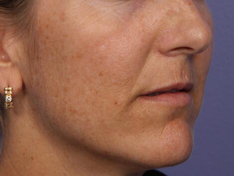 Laser Skin Resurfacing Before & After Image