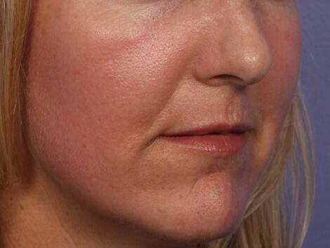 Laser Skin Resurfacing Before & After Image