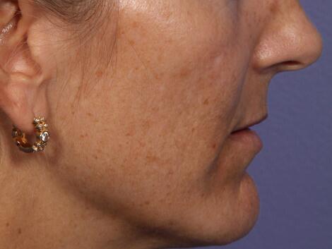 Laser Skin Resurfacing Before & After Image