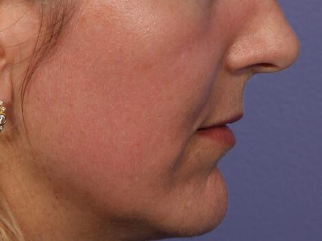 Laser Skin Resurfacing Before & After Image