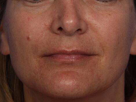 Laser Skin Resurfacing Before & After Image