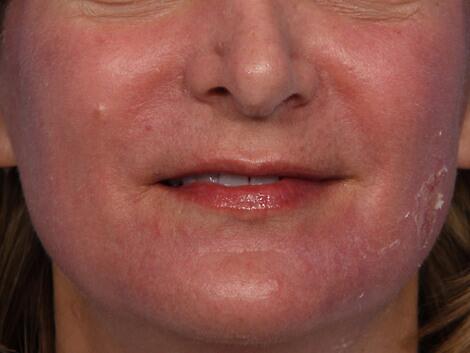 Laser Skin Resurfacing Before & After Image