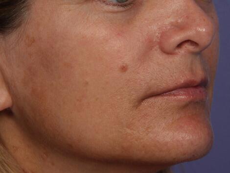 Laser Skin Resurfacing Before & After Image