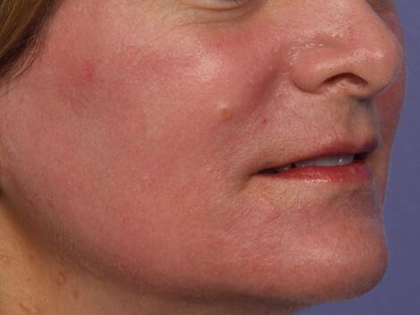 Laser Skin Resurfacing Before & After Image