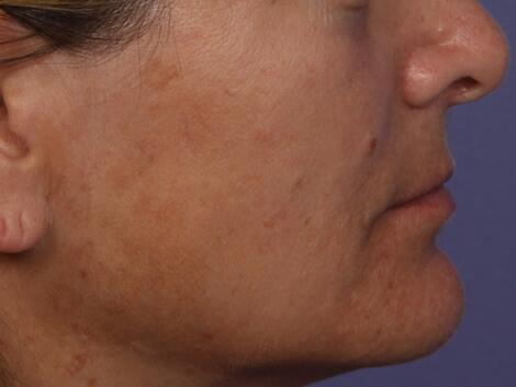 Laser Skin Resurfacing Before & After Image