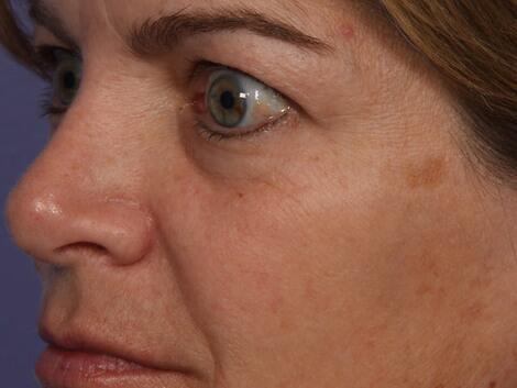 Laser Skin Resurfacing Before & After Image