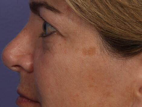 Laser Skin Resurfacing Before & After Image