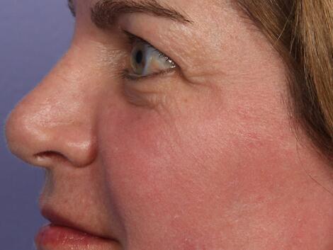 Laser Skin Resurfacing Before & After Image