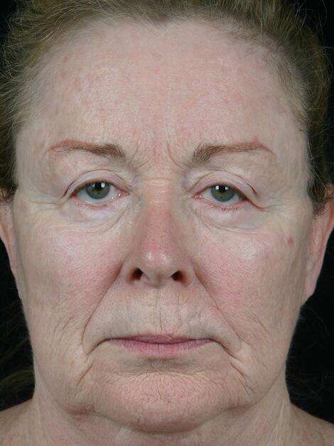 Laser Skin Resurfacing Before & After Image