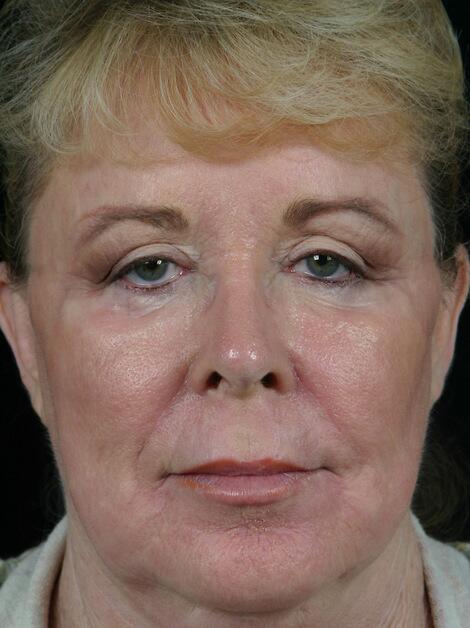 Laser Skin Resurfacing Before & After Image