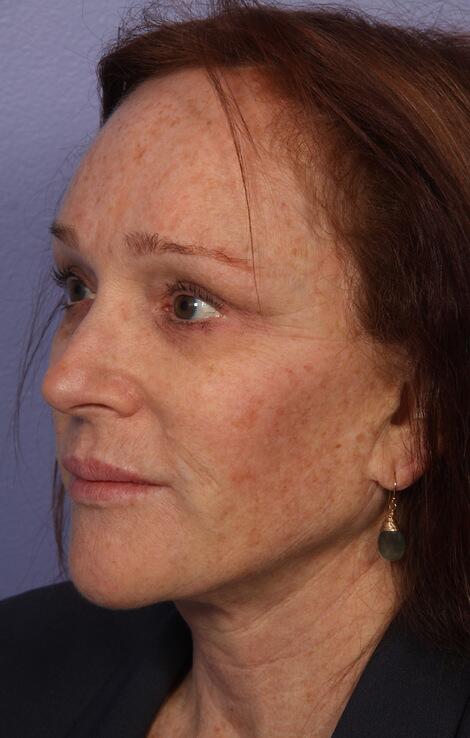 Laser Skin Resurfacing Before & After Image