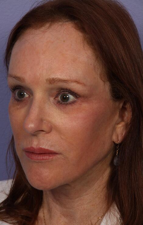 Laser Skin Resurfacing Before & After Image