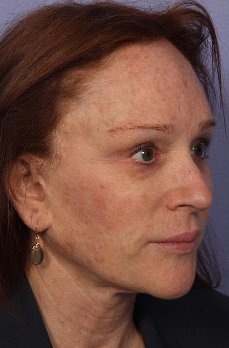 Laser Skin Resurfacing Before & After Image