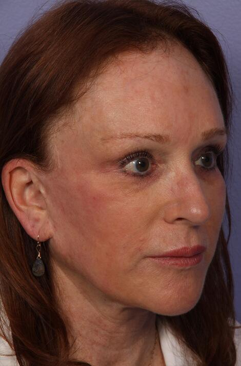 Laser Skin Resurfacing Before & After Image