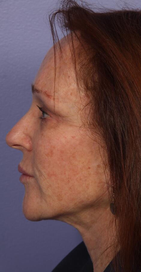 Laser Skin Resurfacing Before & After Image