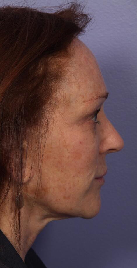 Laser Skin Resurfacing Before & After Image