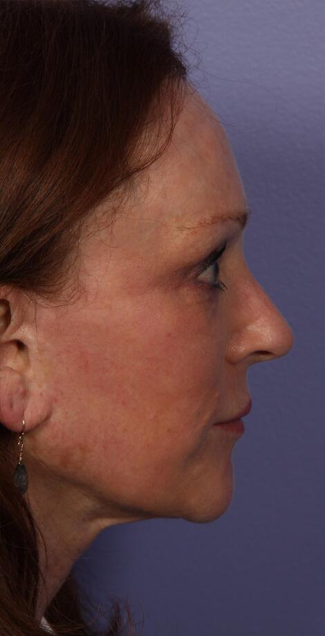 Laser Skin Resurfacing Before & After Image