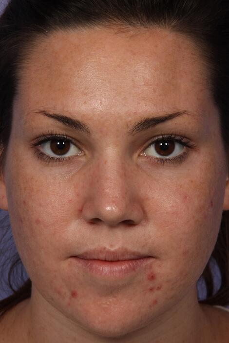 Laser Skin Resurfacing Before & After Image