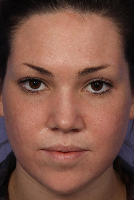 Laser Skin Resurfacing Before & After Image