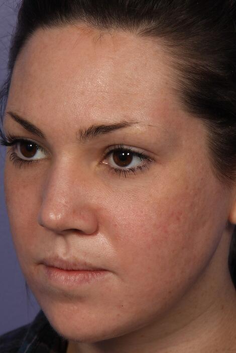 Laser Skin Resurfacing Before & After Image