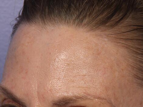 Laser Skin Resurfacing Before & After Image