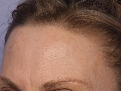 Laser Skin Resurfacing Before & After Image