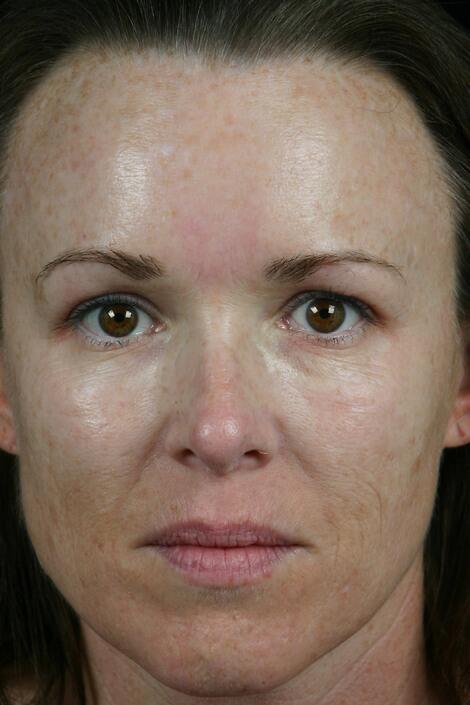 Laser Skin Resurfacing Before & After Image