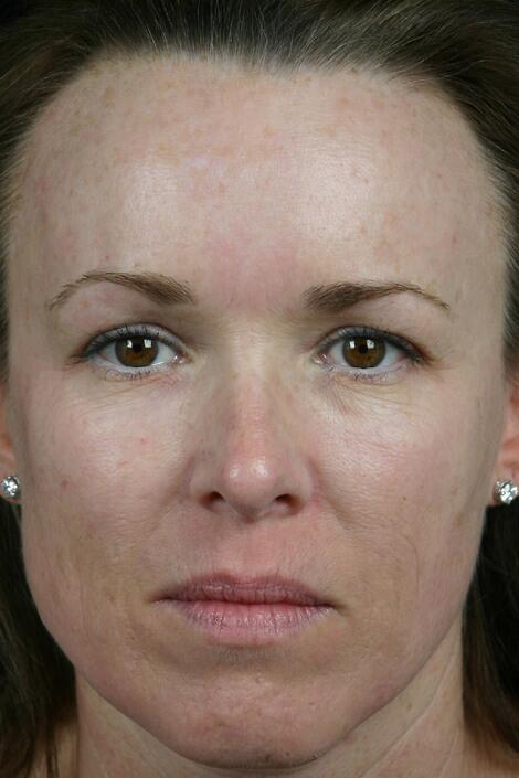 Laser Skin Resurfacing Before & After Image