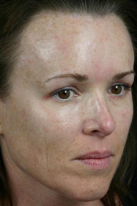 Laser Skin Resurfacing Before & After Image