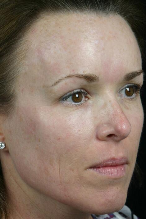 Laser Skin Resurfacing Before & After Image