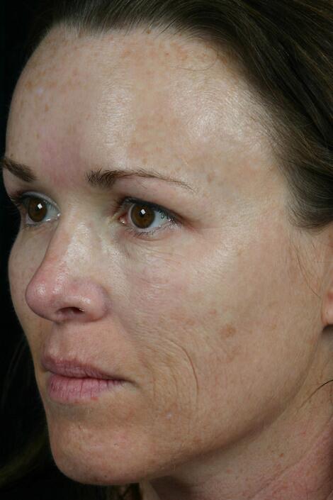 Laser Skin Resurfacing Before & After Image