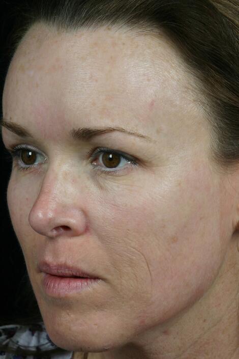 Laser Skin Resurfacing Before & After Image