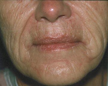 Laser Skin Resurfacing Before & After Image