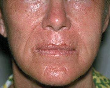 Laser Skin Resurfacing Before & After Image